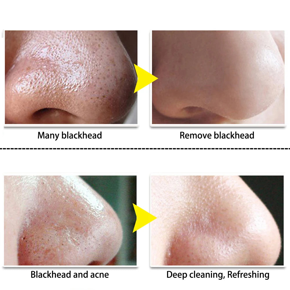 LANBENA NOSE BLACKHEAD REMOVER MASK