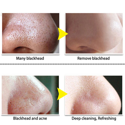 LANBENA NOSE BLACKHEAD REMOVER MASK